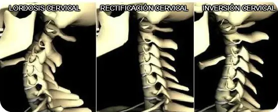 Curva cervical y dolor. Ángulos cervicales.